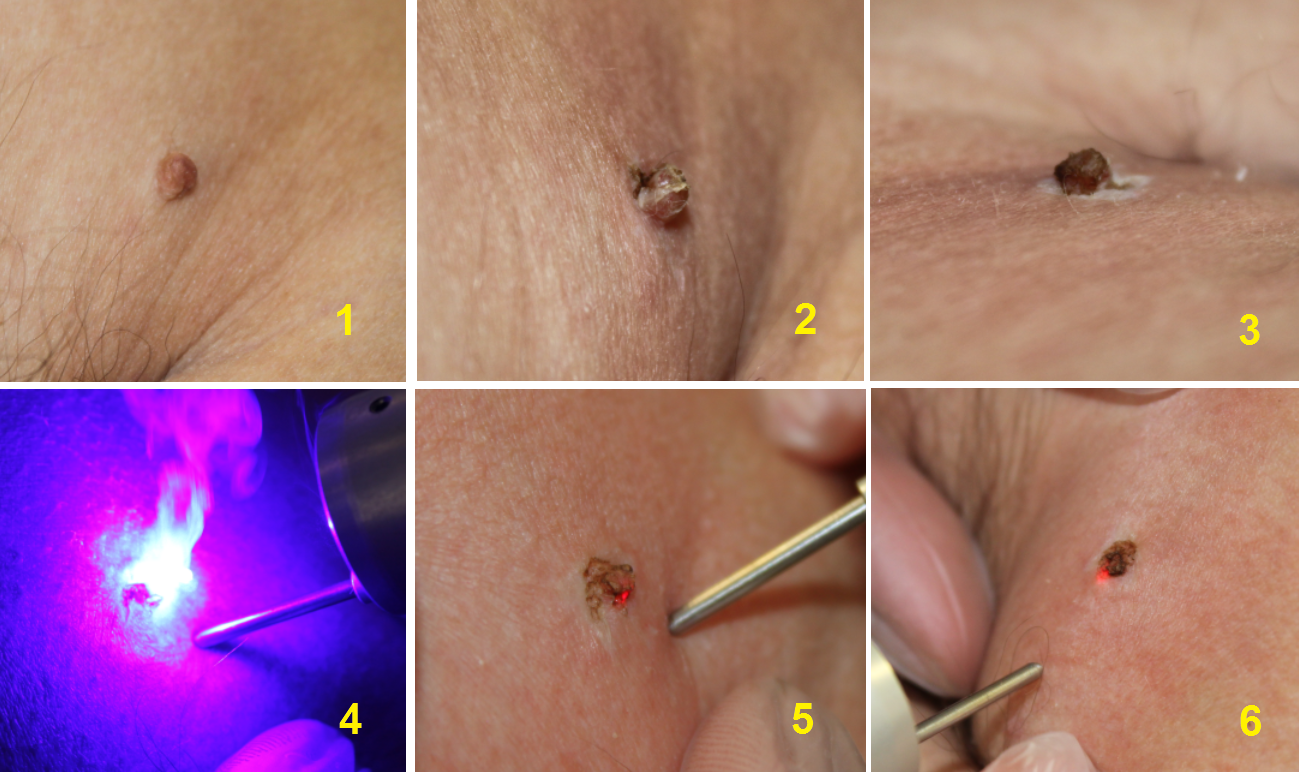 Treatment step by step 1.png