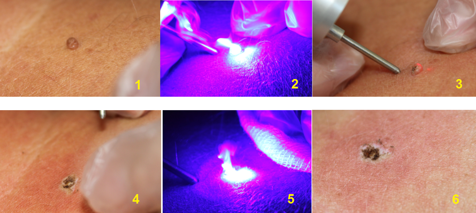 Treatment step by step 2.png