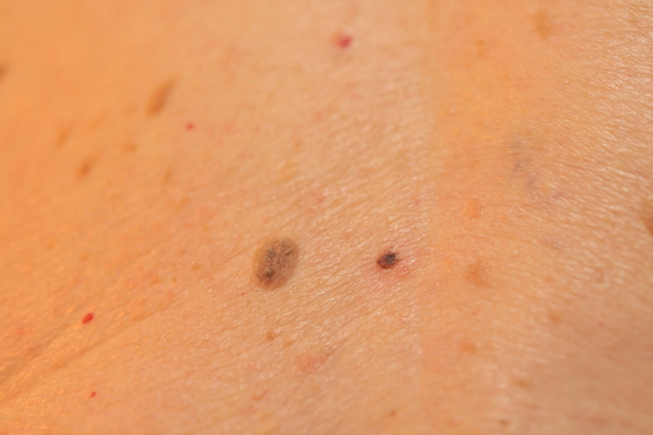 KERASTOSIS SEBORRHEIC.jpeg