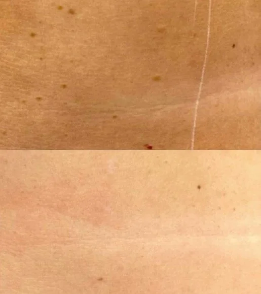 keratosis + kersenangioma.jpg
