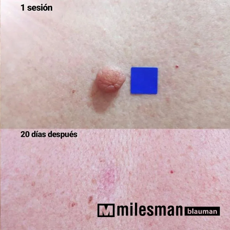 voor en na firboom.jpg