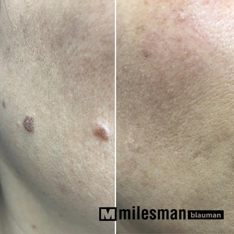 voor en na keratosis.jpg