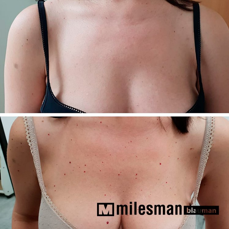 voor en na kersenangiomen.jpg