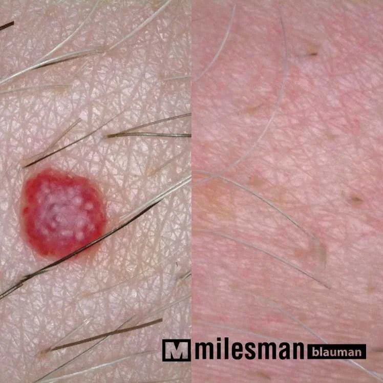 voor en na kersensangioom.jpg