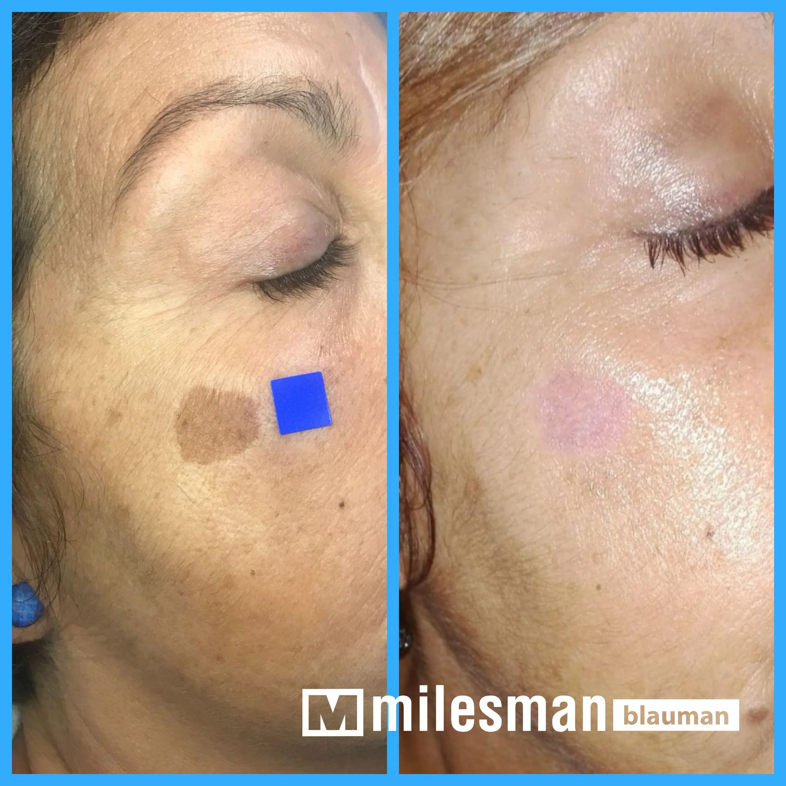 voor en na lentigo (1).jpg