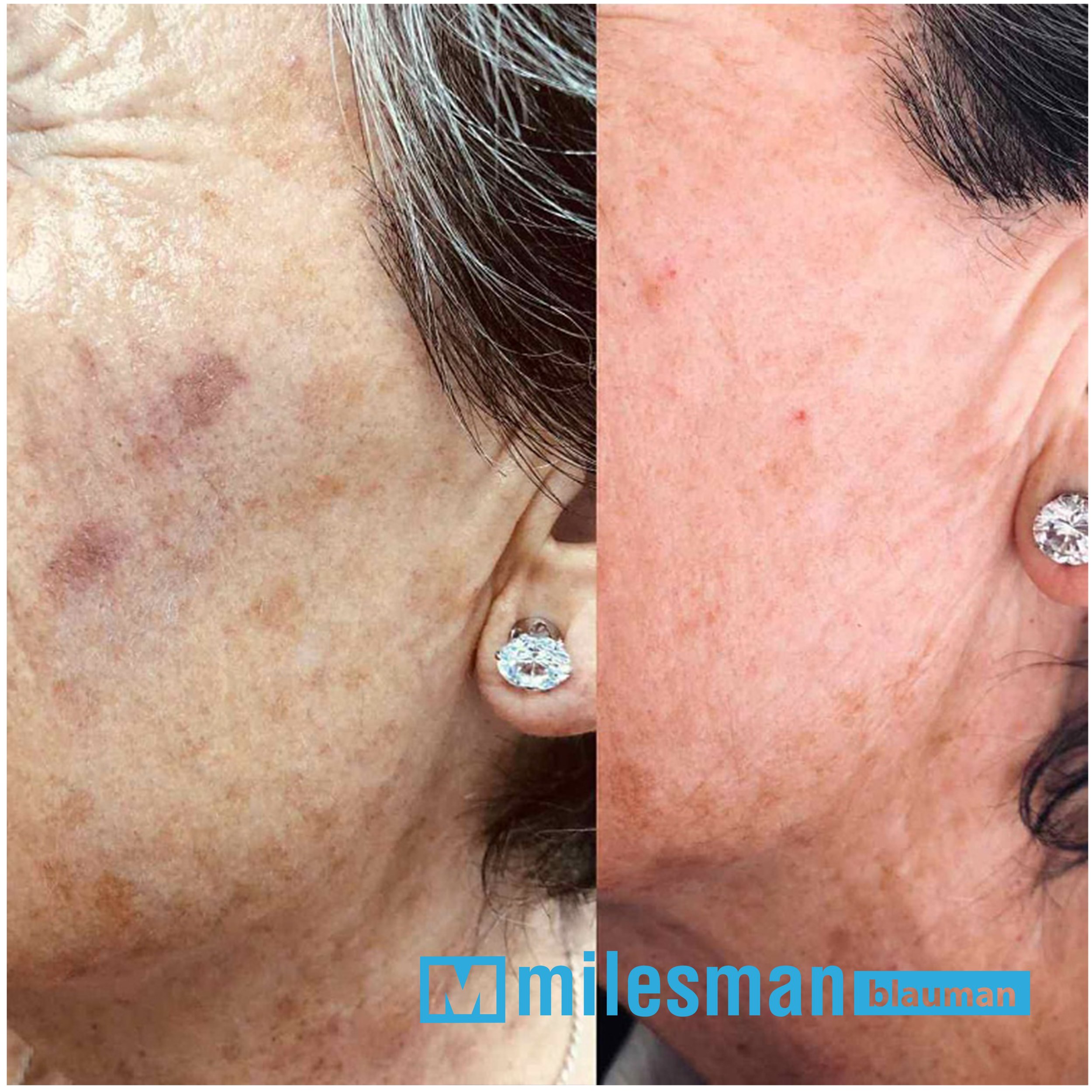 voor en na lentigo (2).jpg