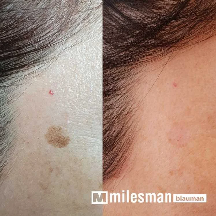 voor en na lentigo (3).jpg