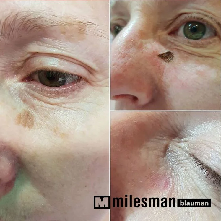 voor en na lentigo (4).jpg