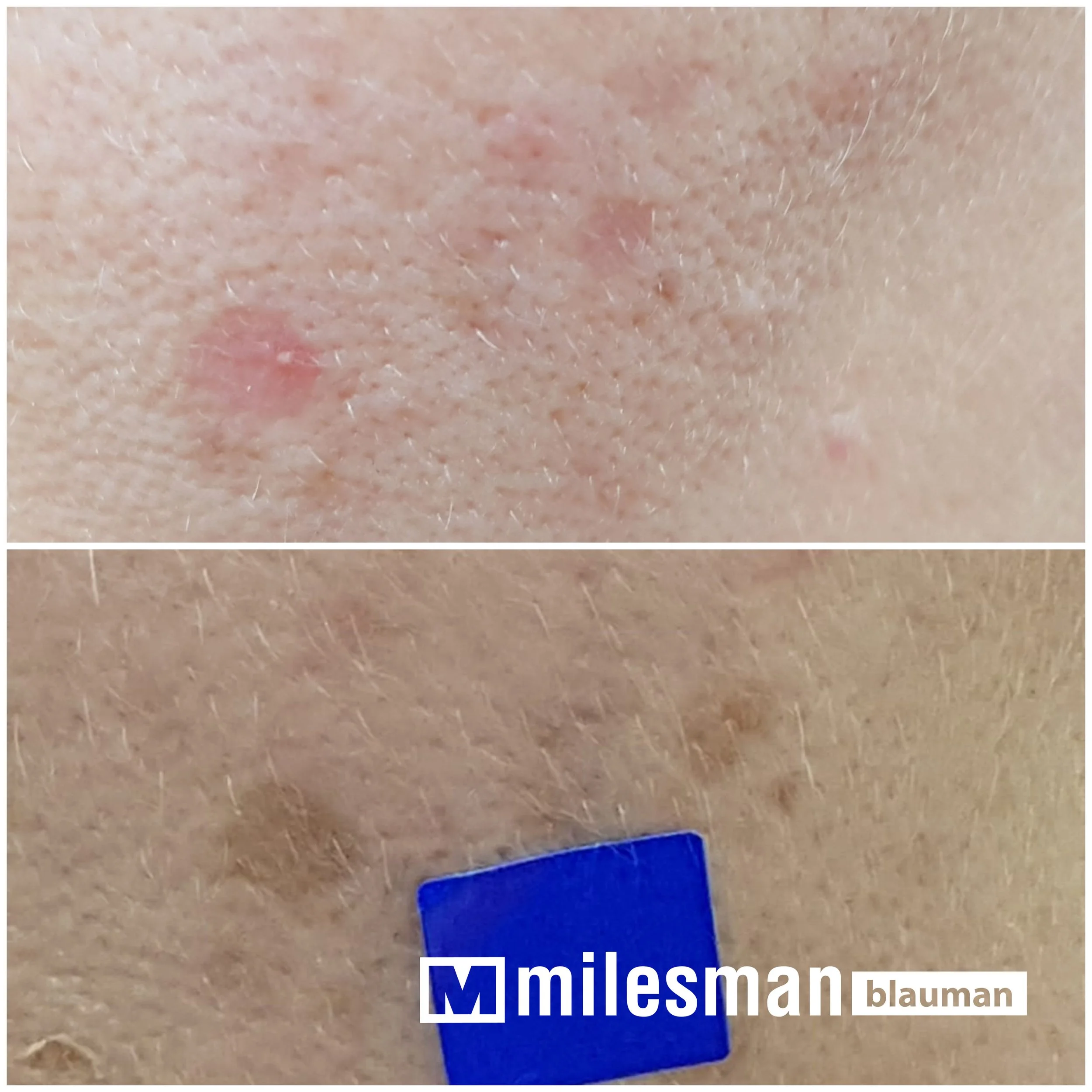 Voor en na lentigo.jpg