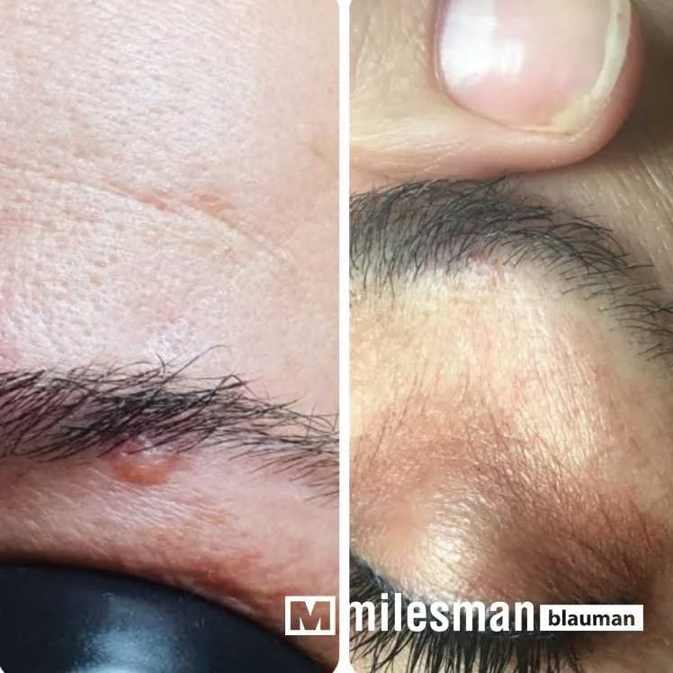 voor en na naevus wenkbrauw.jpg