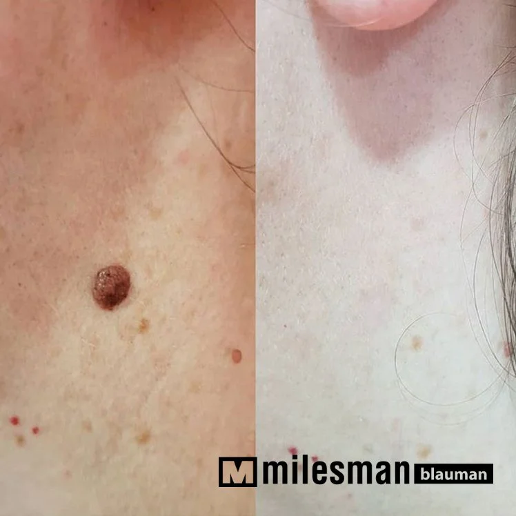 voor en na naevus.jpg