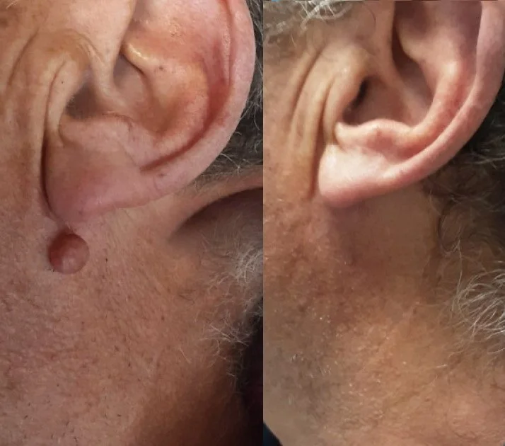 antes-y-despues-milesman-blauman-nevus_2 (11.jpg