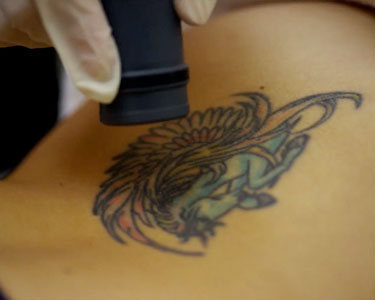 Laser Tattoo Removal Baltimore