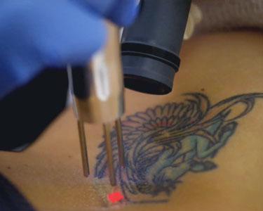 Laser Tattoo Removal Baltimore