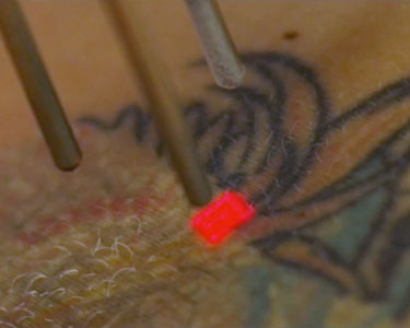ONE SESSION of Tatt2Away Tattoo Removal at Black Lotus Tat  Flickr