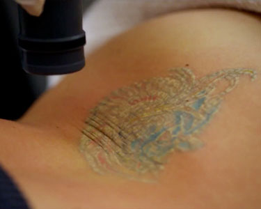 Baltimore Tattoo Removal