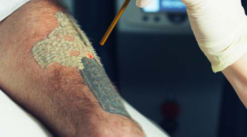 Baltimore Tattoo Removal