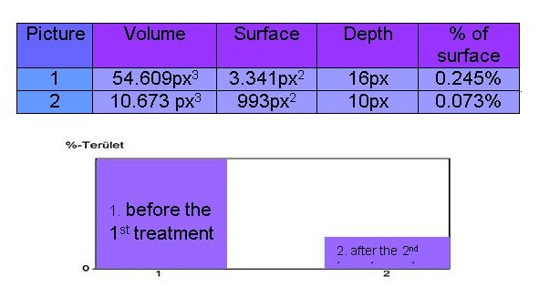  before the 1st treatment after the 2nd treatment