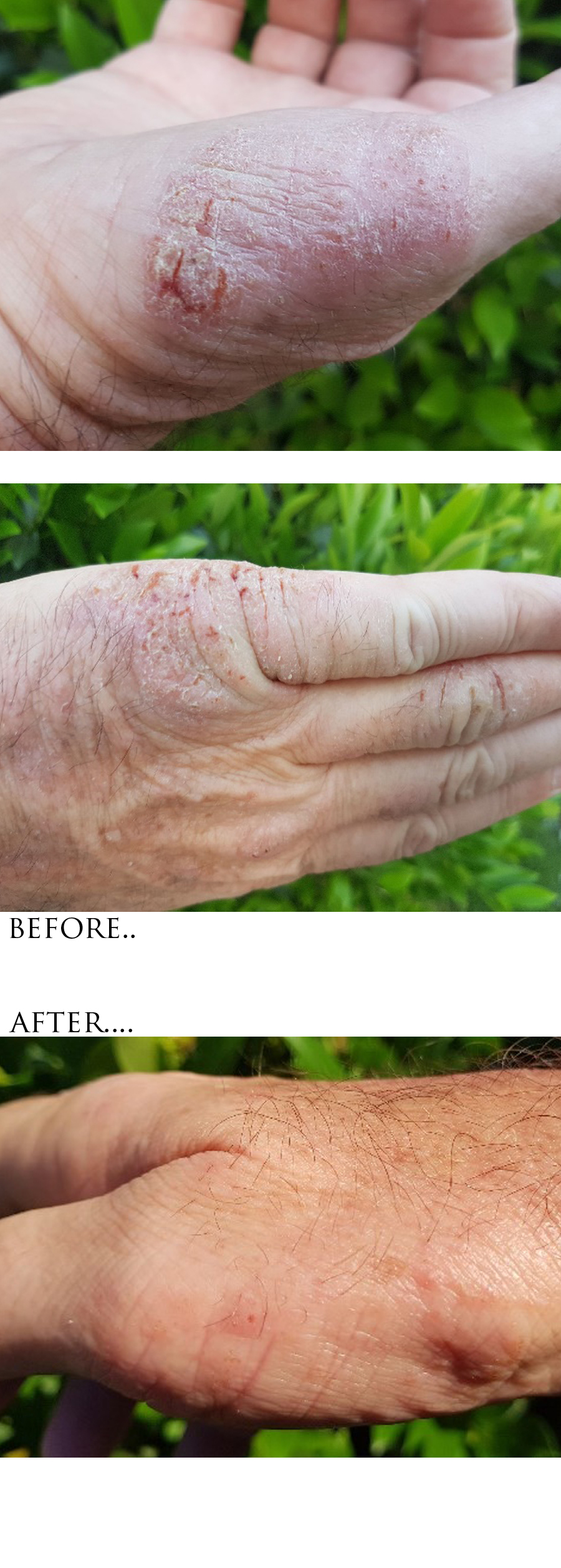 ECZEMA FINAL.jpg