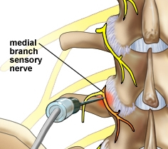 RFD advance healthcare back pain boronia stalbans bundoora hoppers