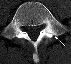 A pars stress fracture as seen on a CT scan