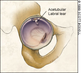  Schematic representation of labral tear. Image courtesy www.aafp.org