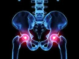 I have a labral tear in my hip, do I need surgery?