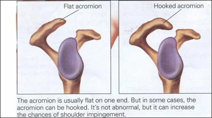 &nbsp;&nbsp;&nbsp;&nbsp;&nbsp;&nbsp;&nbsp;&nbsp;&nbsp;&nbsp;&nbsp;&nbsp;&nbsp;&nbsp;&nbsp;&nbsp;&nbsp;&nbsp;&nbsp;&nbsp;&nbsp; A change in the shape of the acromion (which often occurs normally&nbsp;through&nbsp;the lifespan), can contribute to Primary Impingement.  &nbsp;&nbsp;&nbsp;&nbsp;&nbsp;&nbsp;&nbsp;&nbsp;&nbsp;&nbsp;&nbsp;&nbsp;&nbsp;&nbsp;&nbsp;&nbsp;&nbsp;&nbsp;&nbsp;&nbsp;&nbsp;&nbsp; Image courtesy  www.sportsandortho.com   