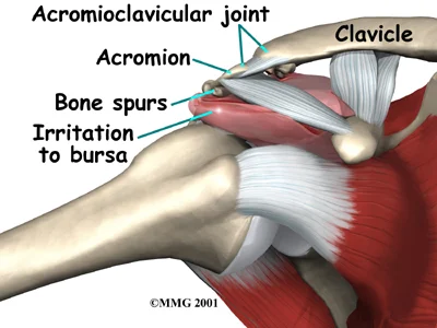 A close up view of the mechanisms leading to Primary Impingement  &nbsp;&nbsp;&nbsp;&nbsp;&nbsp;&nbsp;&nbsp;&nbsp;&nbsp;&nbsp;&nbsp;&nbsp;&nbsp;&nbsp;&nbsp;&nbsp;&nbsp;&nbsp; Image courtesy  www.methodistorthopaedics.com   