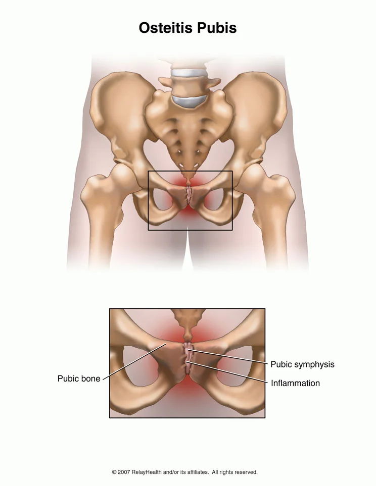 Figure 1: Osteitis Pubis can cause an inflammatory reaction at the joint at the front of the pelvis