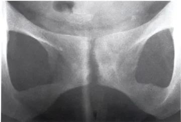 Osteitis Pubis and Chronic groin Pain