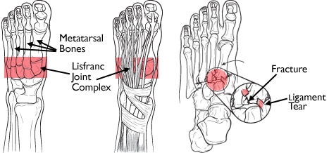 Fig 1.&nbsp; Lisfranc injury (Courtesy of OrthoInfo:    http://orthoinfo.aaos.org/topic.cfm?topic=A00162   )
