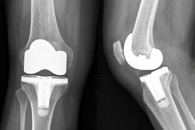 knee replacement.jpg