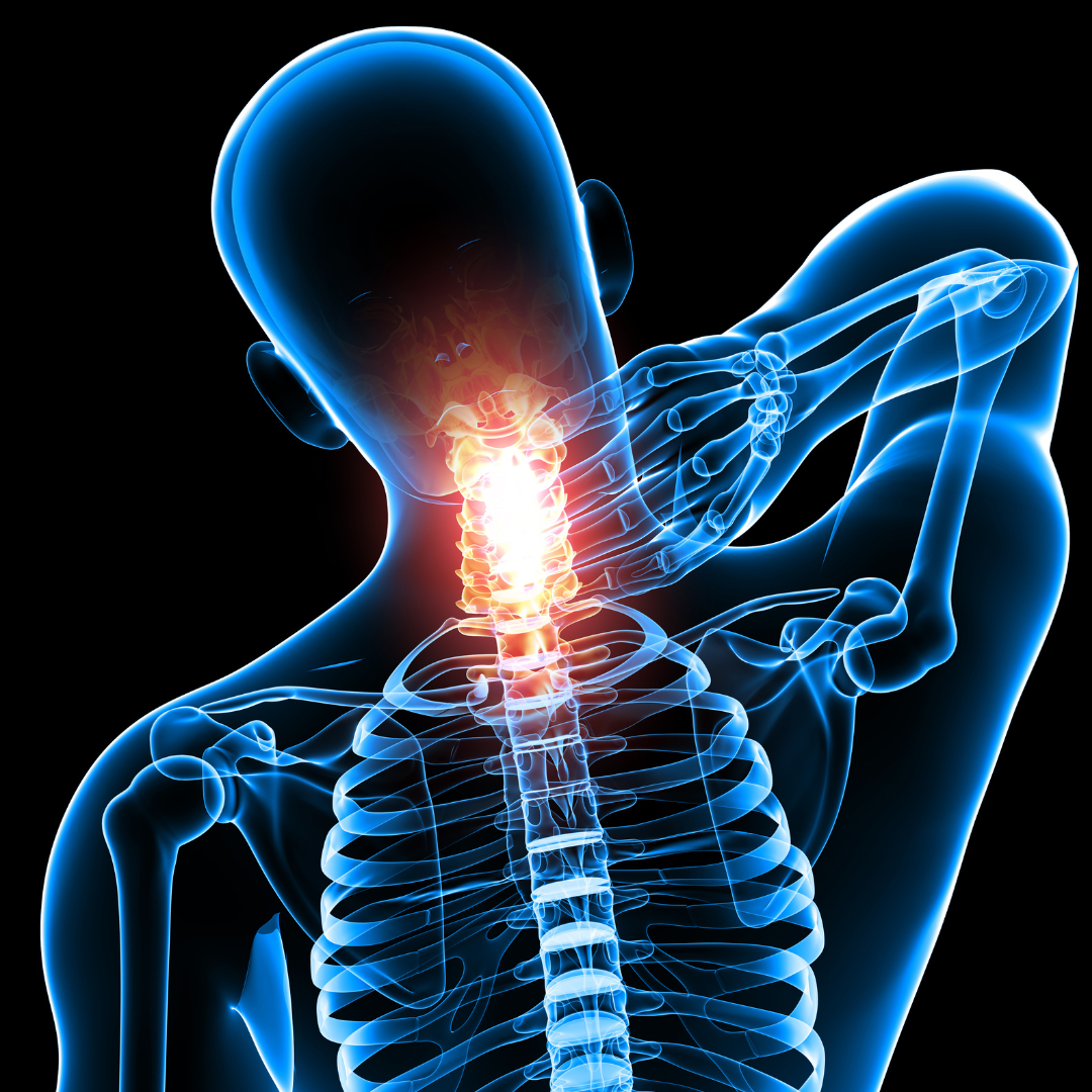 Supporting Recovery from Cervical Radiculopathy