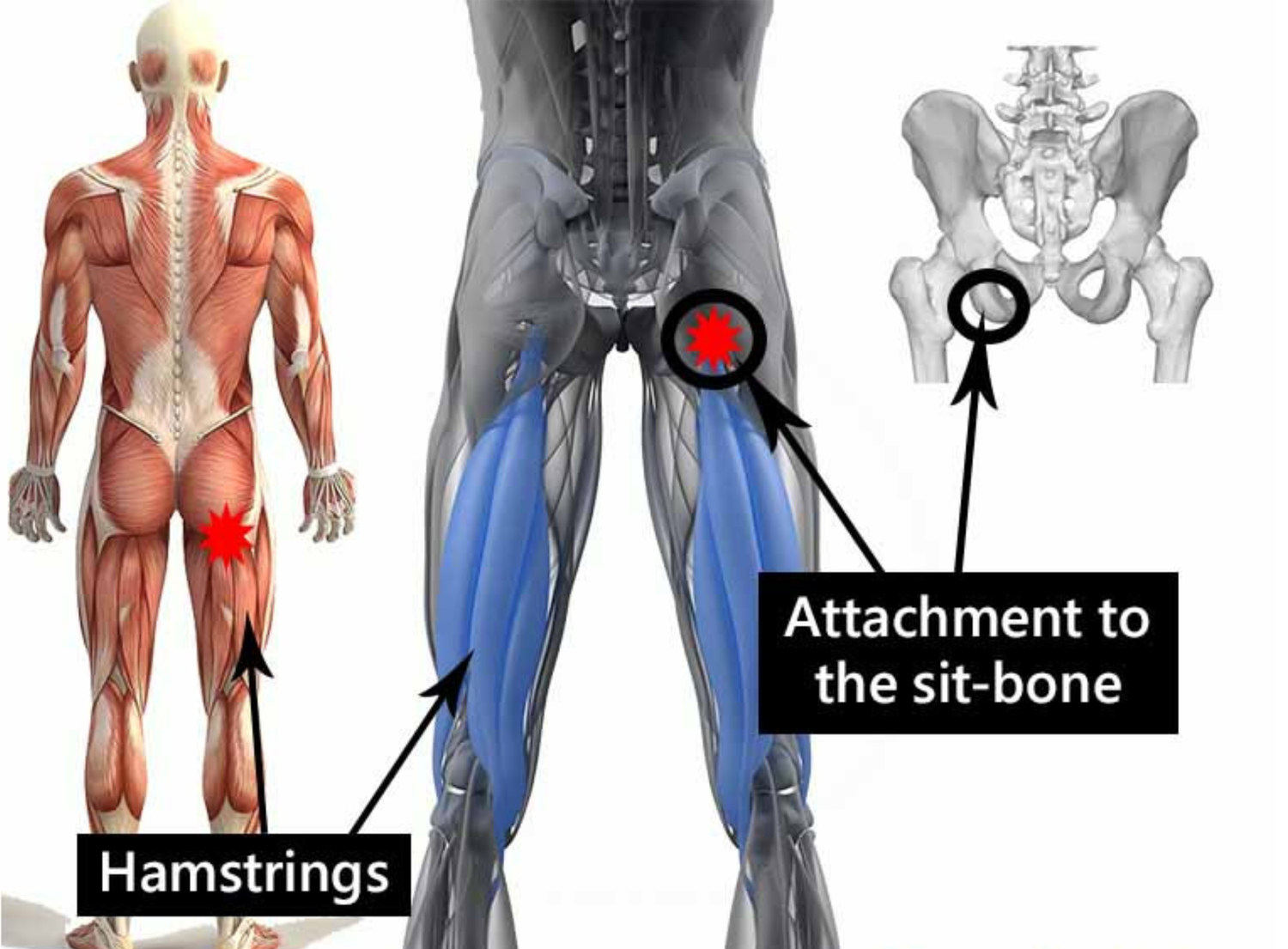 Proximal hamstring tendionpathy — Advance Healthcare