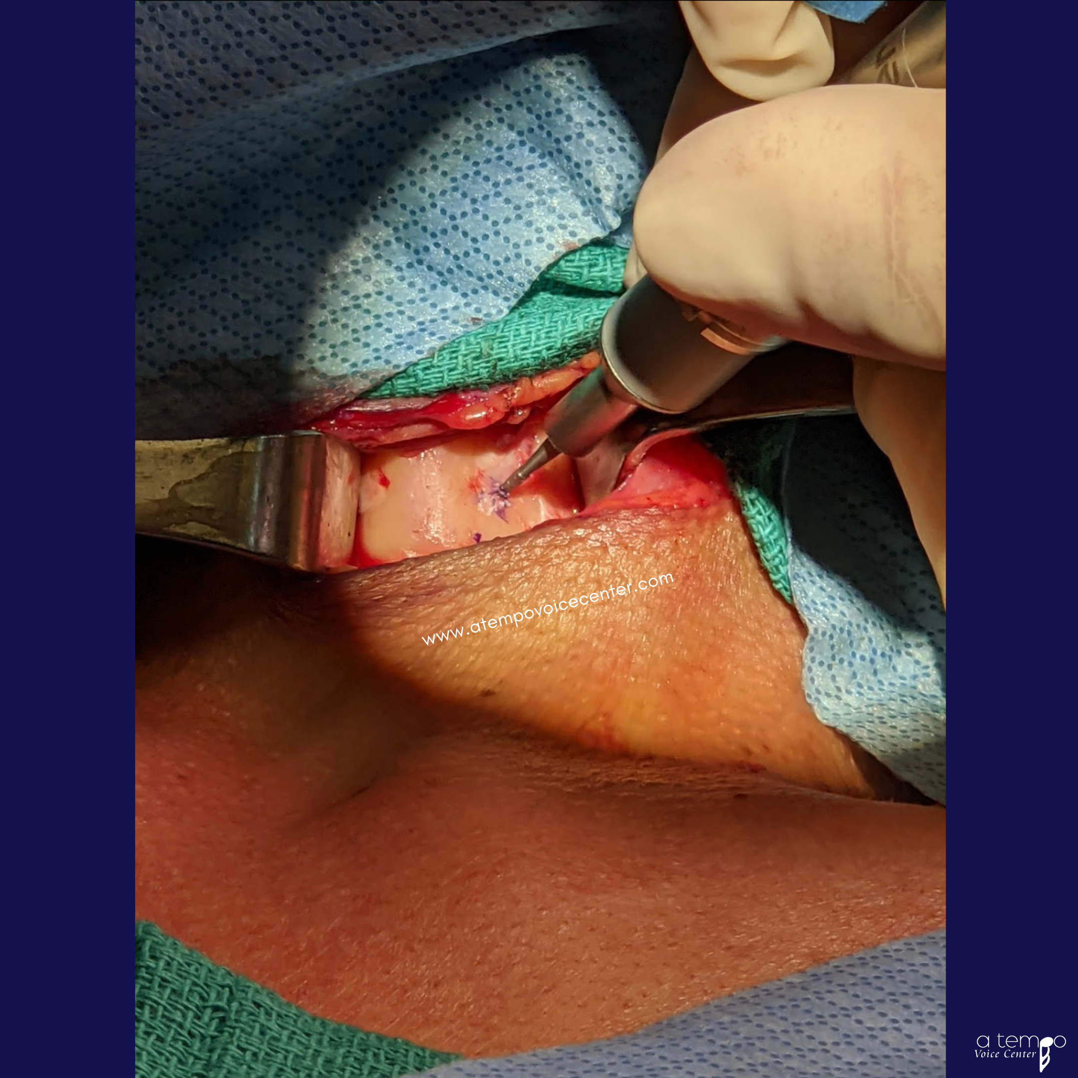 接下来，用钻头在甲状软骨上钻一个小而浅的洞。这是病人脖子的左侧。