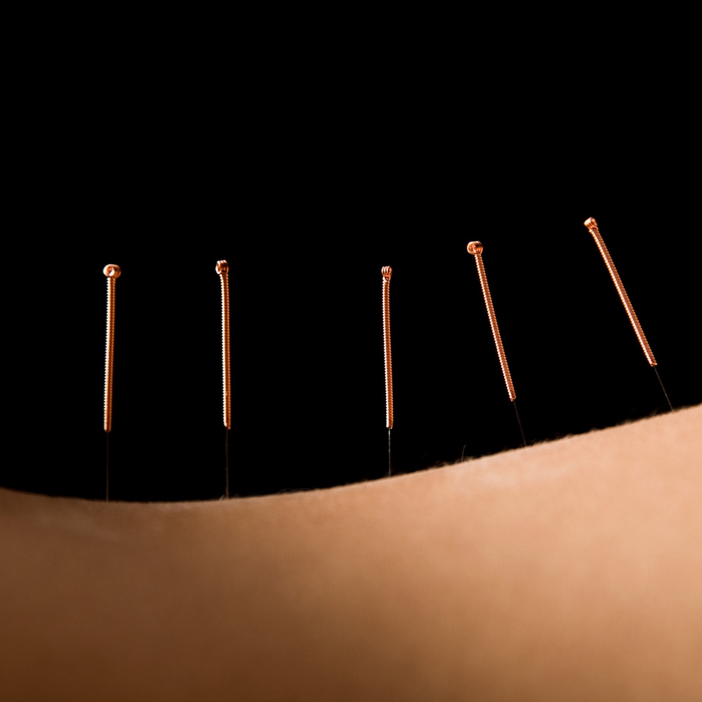 acupuncture-Fotolia_7674024_L.jpg