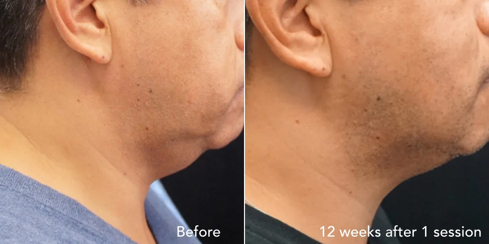 CS before & after - updated 3.017.jpeg