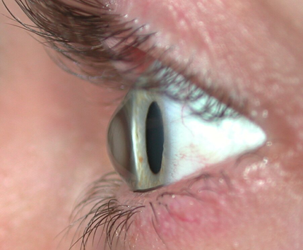 cornea mishapen.png