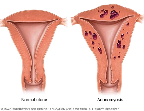 Menstruar duas vezes no mês o que é? #ginecologia #mulher