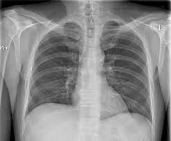 thorax.jpeg
