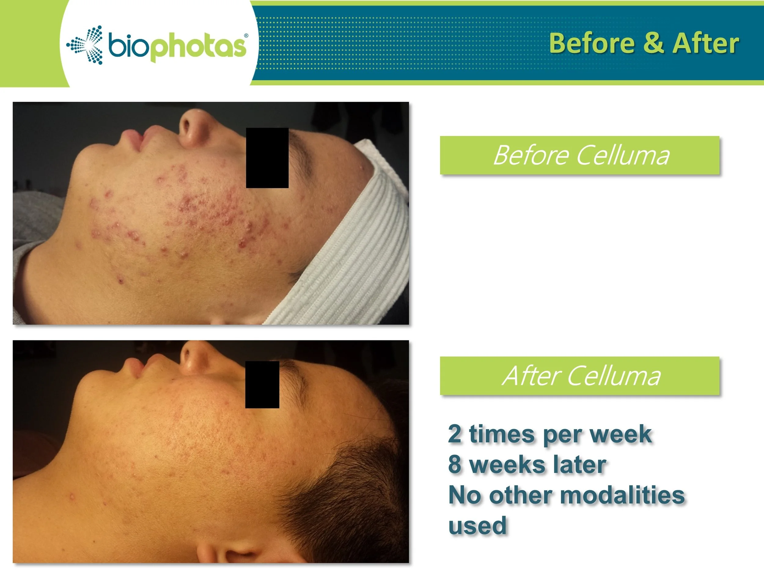 Celluma LED Light Therapy