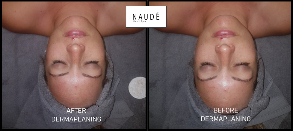 Before and After Dermaplaning.png