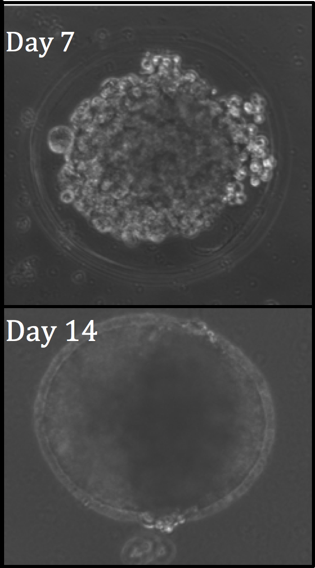 Developing tumor spheroid within LDW microcapsule