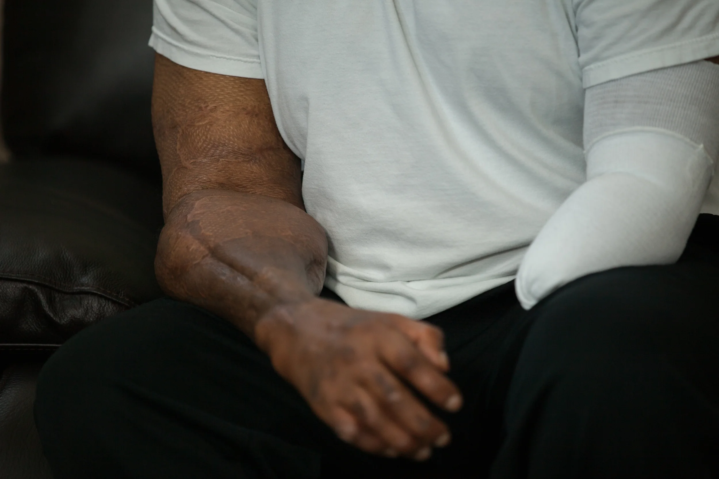  Glenn Johnson in his fifties now,&nbsp;was injured in a smelting accident near Amarillo in the late 90s. A furnace exploded, crushed him and left major burns over 90% of his body. His left arm was amputated and all but two the muscles in his right f