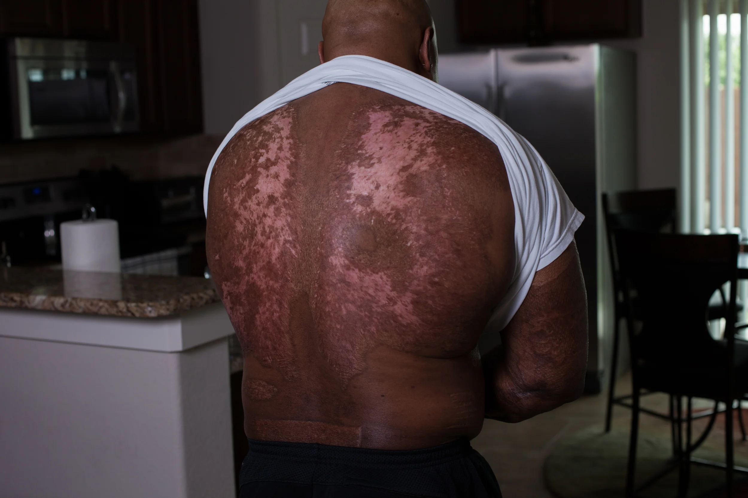  Burn and skin graft scars on Glenn Johnson's back. He was injured at work when a smelting furnace filled with molten metal exploded, crushed him and left severe burns over ninety percent of his body.&nbsp;&nbsp;He and his lawyer battled with the ins