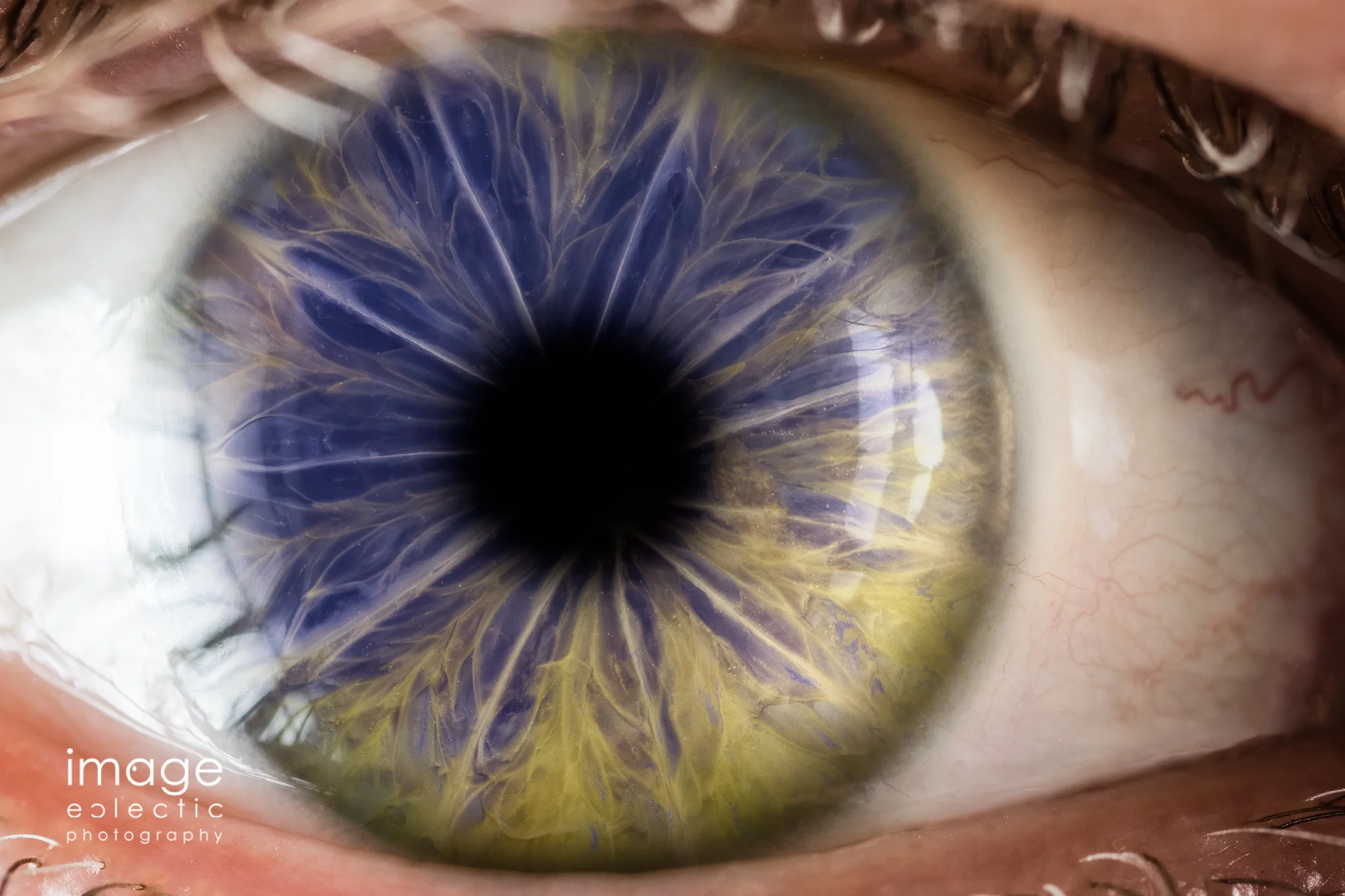 Heterochromia Cinis
