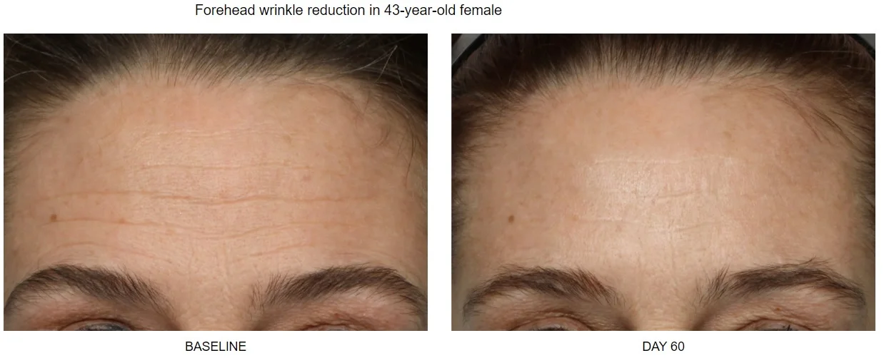 Achieved without surgery or injections!