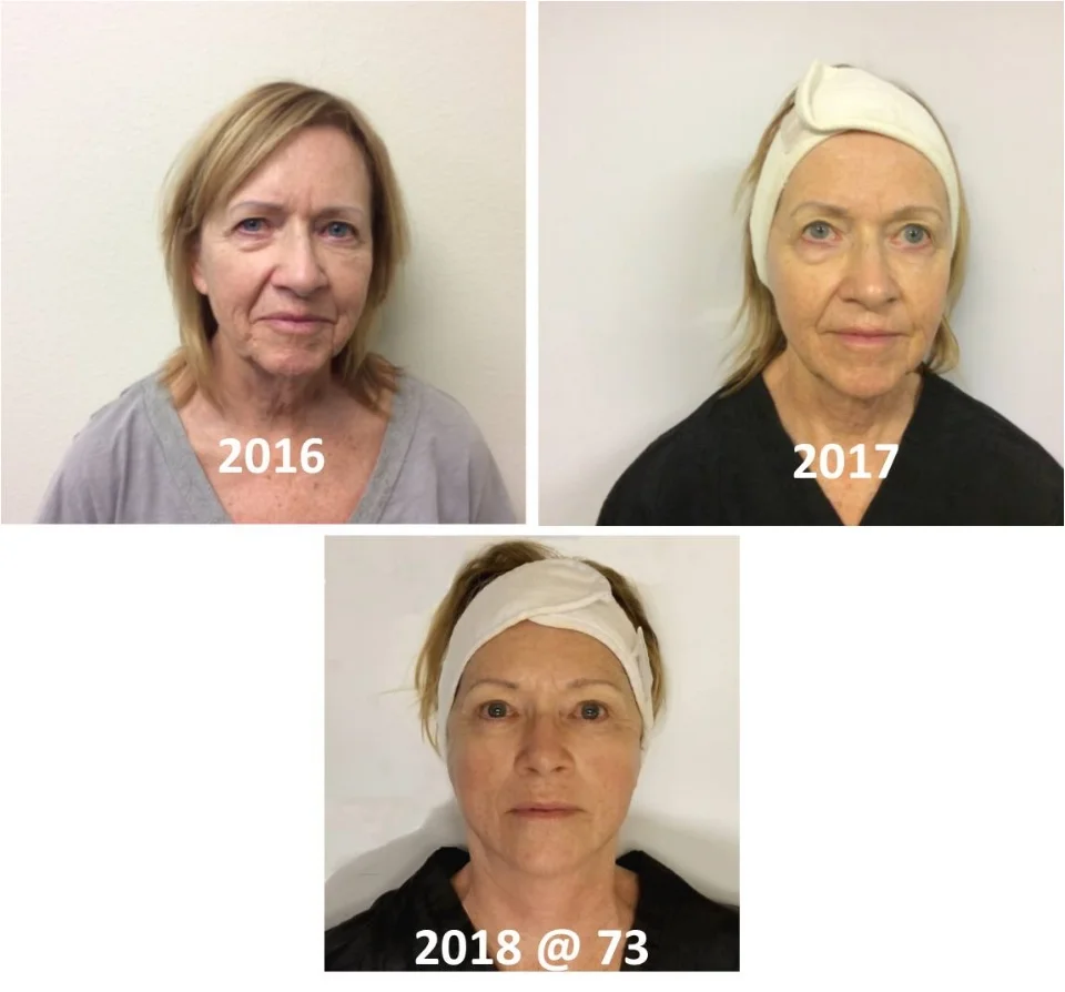 neurotris before and after.jpg