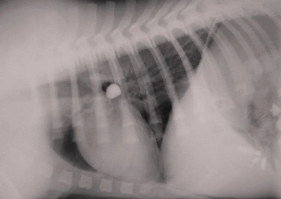 Tracheal pebble foreign body